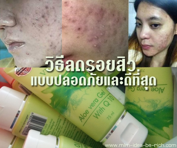 %e0%b8%a7%e0%b8%b4%e0%b8%98%e0%b8%b5%e0%b8%a5%e0%b8%94%e0%b8%a3%e0%b8%ad%e0%b8%a2%e0%b8%aa%e0%b8%b4%e0%b8%a7-acne-aloe-vera