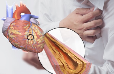 %e0%b9%84%e0%b8%82%e0%b8%a1%e0%b8%b1%e0%b8%99%e0%b9%83%e0%b8%99%e0%b9%80%e0%b8%a5%e0%b8%b7%e0%b8%ad%e0%b8%94%e0%b8%aa%e0%b8%b9%e0%b8%87-hypercholesterolemia