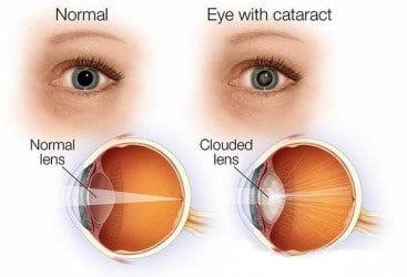 %e0%b8%95%e0%b9%89%e0%b8%ad%e0%b8%81%e0%b8%a3%e0%b8%b0%e0%b8%88%e0%b8%81-cataract